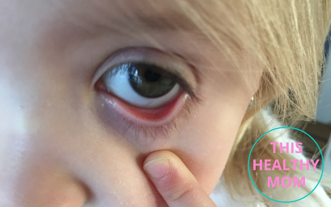 What Can Your Child’s Lower Eyelids Tell You About Low Iron Levels?